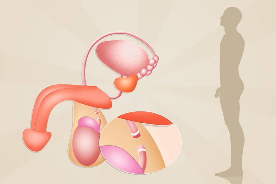 vasektomie - mužská antikoncepce
